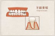 左归丸+归脾丸可预防牙齿萎缩、牙齿脱落